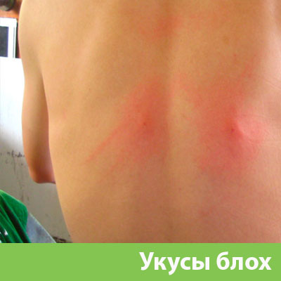 Укусы блох в Копейске
