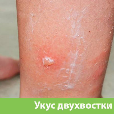 Укус двухвостки в Копейске