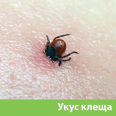 Укус клеща в Копейске