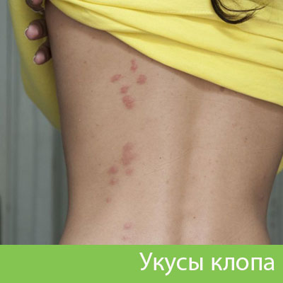 Профессиональное уничтожение клопов в Копейске